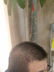 点击看大图 -碧莲盛·不剃发植发