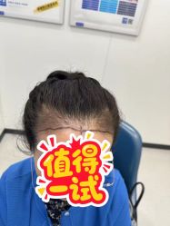 -大麦微针植发全国连锁