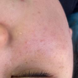 体验前-美丽人生祛斑扁平疣汗管瘤中心
