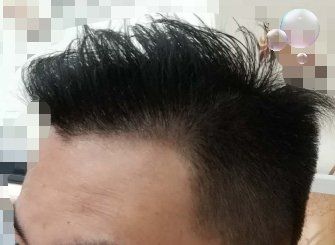 -大麦微针植发丨全国连锁