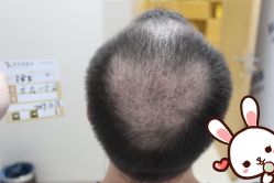 点击看大图 -大麦微针植发丨全国连锁