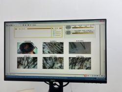 -大麦微针植发全国连锁