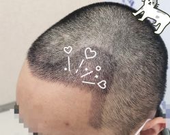 -大麦微针植发全国连锁