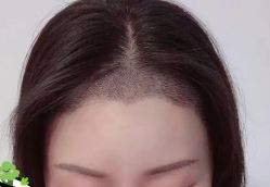 -大麦微针植发丨全国连锁