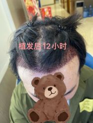 -大麦微针植发全国连锁