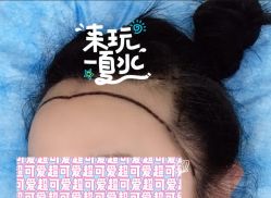 -大麦微针植发全国连锁