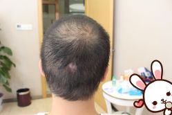 点击看大图 -大麦微针植发丨全国连锁