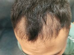 -碧莲盛·不剃发植发