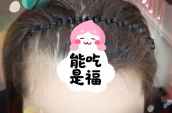 -大麦微针植发全国连锁