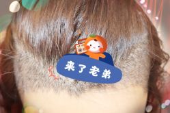 -大麦微针植发全国连锁