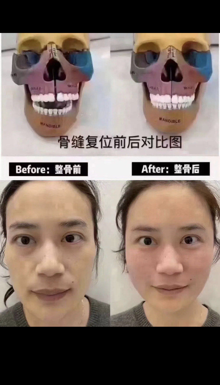 n又想瘦脸又怕开刀磨骨的姐妹一定要尝试一下日本小颜美容整骨n
