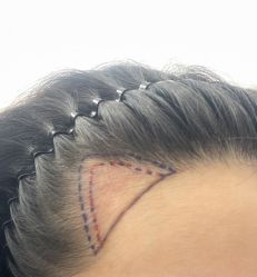 体验前-熙朵美学植发·连锁品牌