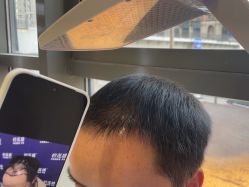 -碧莲盛·不剃发植发