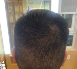 -大麦微针植发丨全国连锁