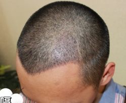 -大麦微针植发丨全国连锁