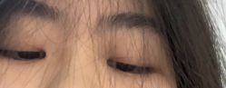 体验后-爱莎扁平疣·汗管瘤·斑痣中心