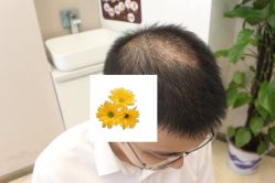 -大麦微针植发丨全国连锁