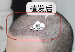 -大麦微针植发全国连锁