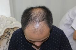 -大麦微针植发丨全国连锁