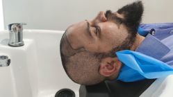 -大麦微针植发全国连锁