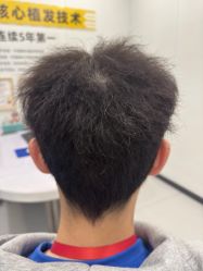 点击看大图 -大麦微针植发全国连锁