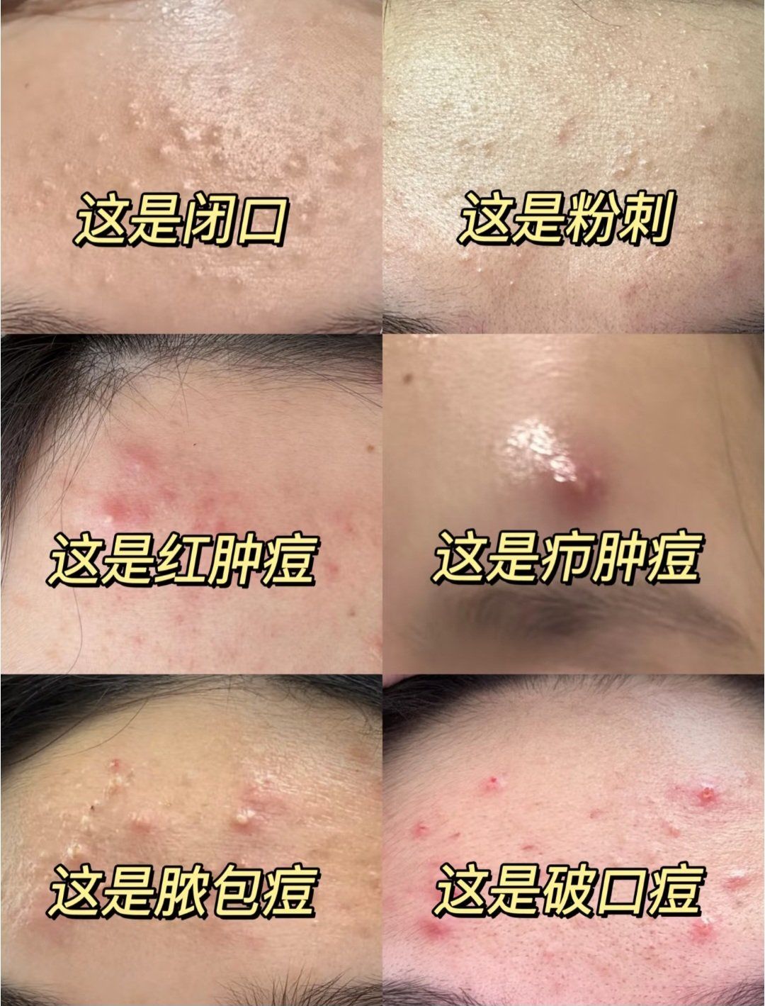 一篇看懂痘痘类型