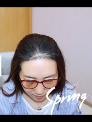 -大麦微针植发全国连锁