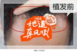 -大麦微针植发全国连锁