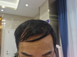 -碧莲盛·不剃发植发