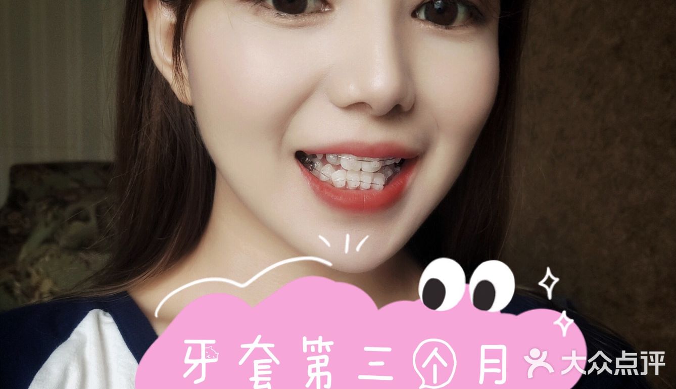 牙齿矫正案例 虎牙小美女逆袭日记