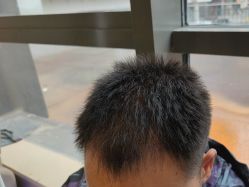 -碧莲盛·不剃发植发