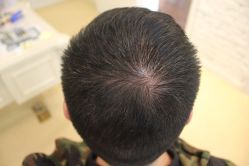 点击看大图 -大麦微针植发丨全国连锁