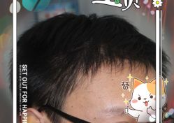 -大麦微针植发全国连锁