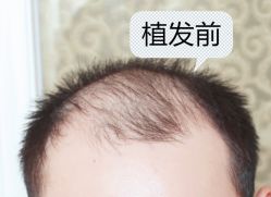 -大麦微针植发全国连锁