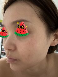 体验前-More摩尔医美の注射线雕光电中心