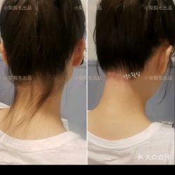 -小梨·OndaPro·专业脱毛连锁机构