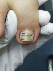 -德哥灰指甲脚气甲沟炎跖疣护理