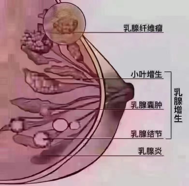 乳腺增生照片图片图片