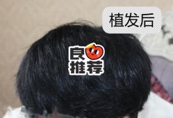 -大麦微针植发全国连锁