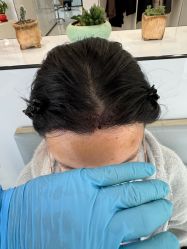 -大麦微针植发丨全国连锁