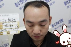 -大麦微针植发丨全国连锁