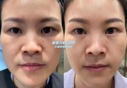 -海涛医疗美容·面部抗衰·注射美鼻