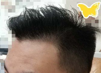 -大麦微针植发丨全国连锁