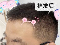 -大麦微针植发全国连锁