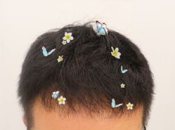 -大麦微针植发全国连锁