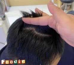 -大麦微针植发丨全国连锁