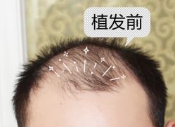 -大麦微针植发全国连锁