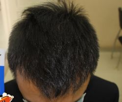 -大麦微针植发丨全国连锁