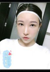 点击看大图 体验后-大麦微针植发全国连锁