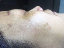 -爱莎扁平疣·汗管瘤·斑痣中心